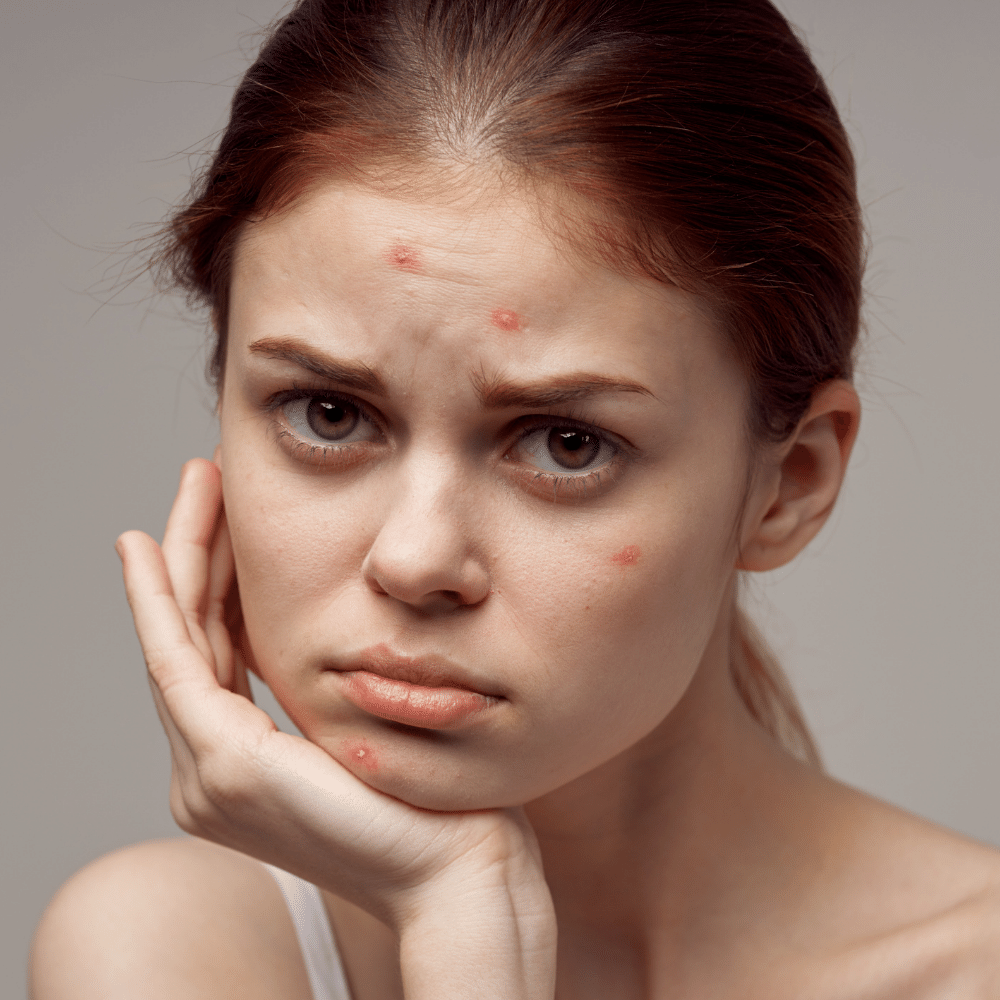 Face Wash for Fungal Acne A Comprehensive Guide