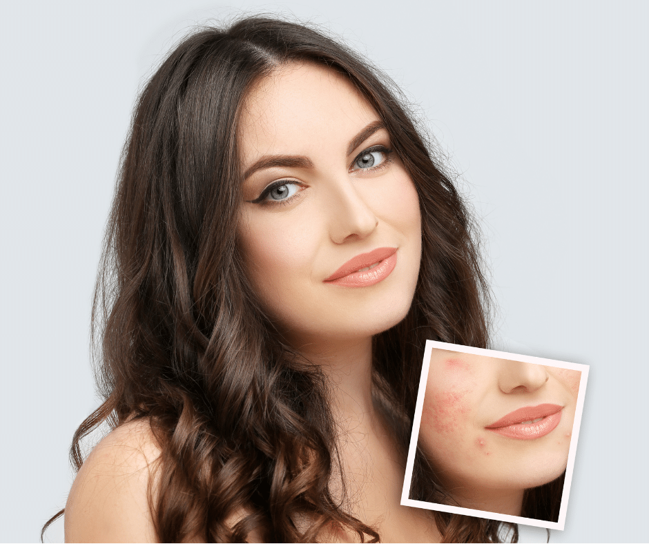 Best Foundation for Acne Scars for Glowing Skin