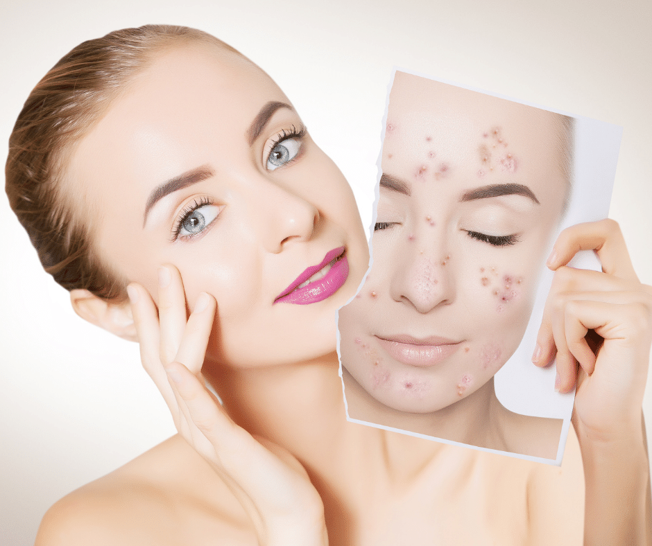 Acne: The Basics, An Estheticians Review